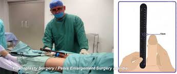 Consultation and Planning Phalloplasty