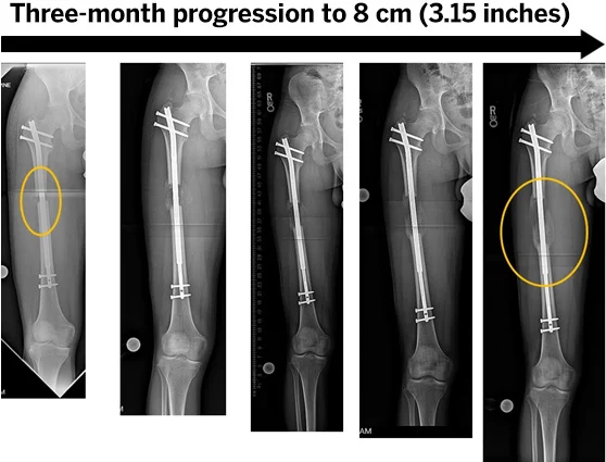 limb-lengthening-surgery
