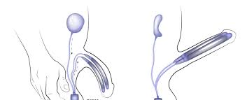 Penile Implant